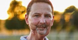 A man who survived chewing tobacco